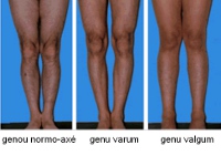 Figure 5 - Knock Knees or Genu valgum